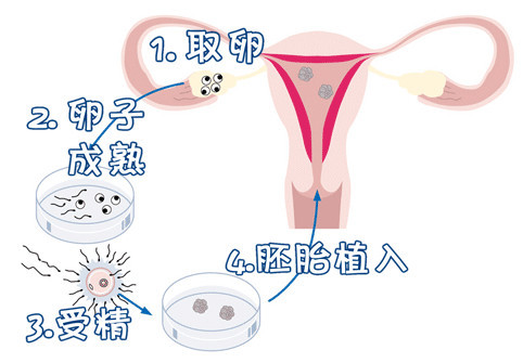 厦门助孕