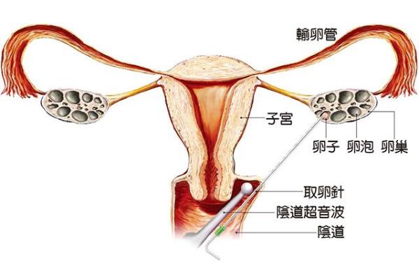 不孕不育